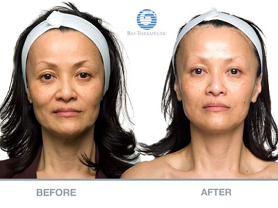 Bio Therapeutic Before and After Treatment